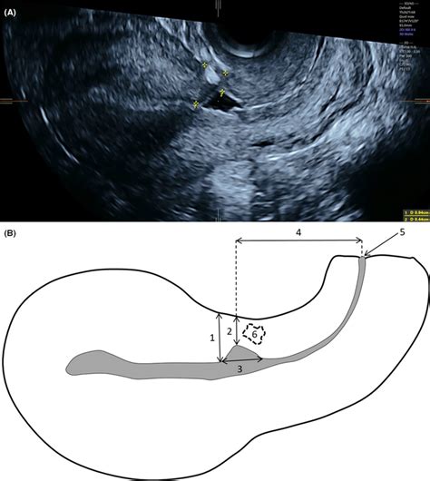 measuring uterine scar thickness on ultrasound|myometrial thickness pregnancy ultrasound.